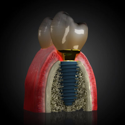 Impianto-con-gengiva-e-corona-400x400
